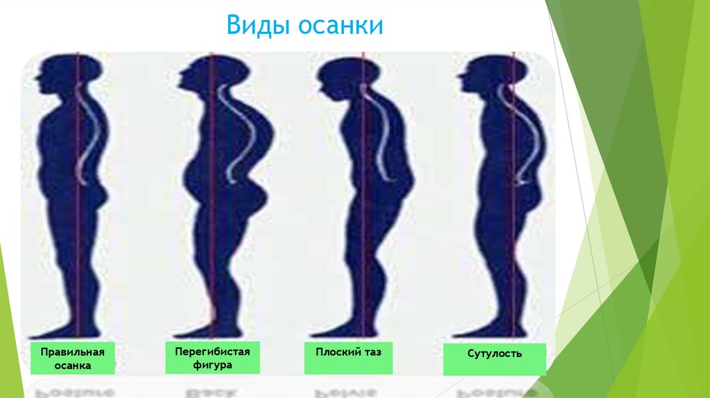 Виды осанки