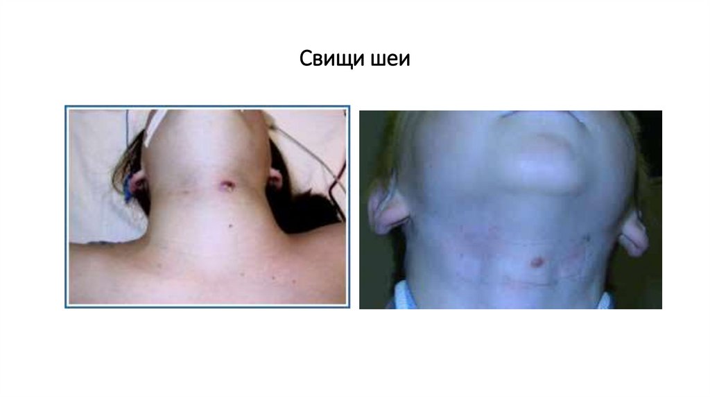 Свищи шеи