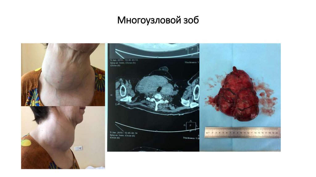 Многоузловой зоб