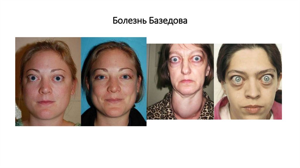 Болезнь Базедова