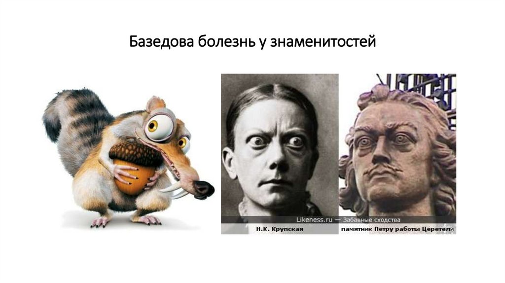 Базедова болезнь у знаменитостей