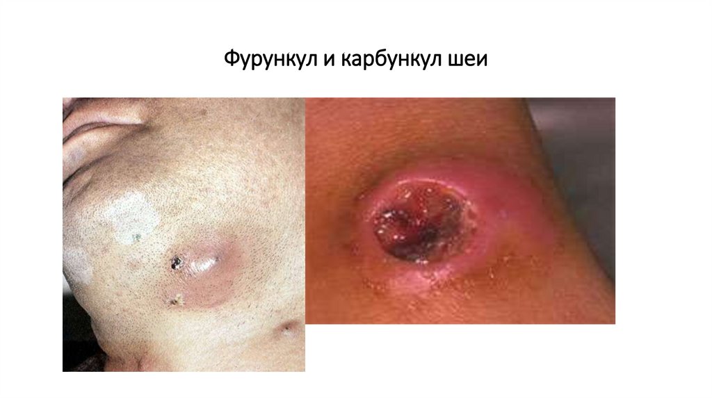 Фурункул и карбункул шеи