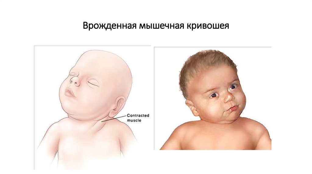 Врожденная мышечная кривошея