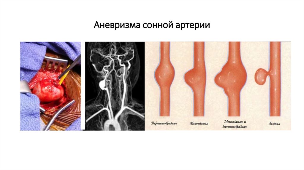Аневризма сонной артерии