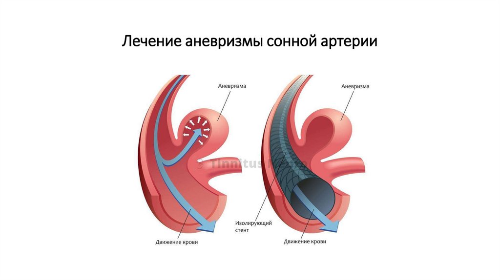 Лечение аневризмы сонной артерии