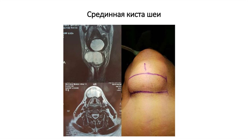 Срединная киста шеи