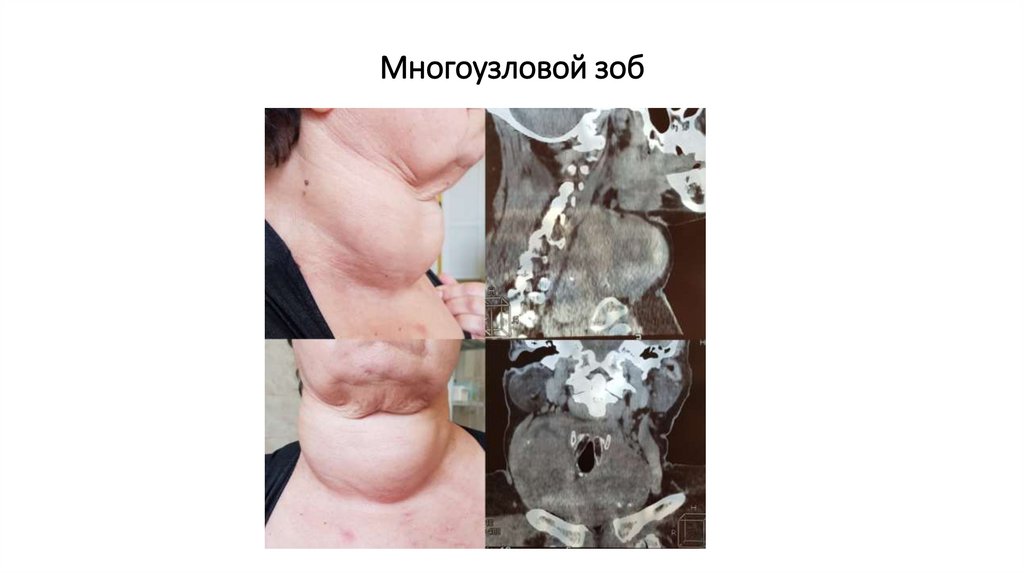 Многоузловой зоб