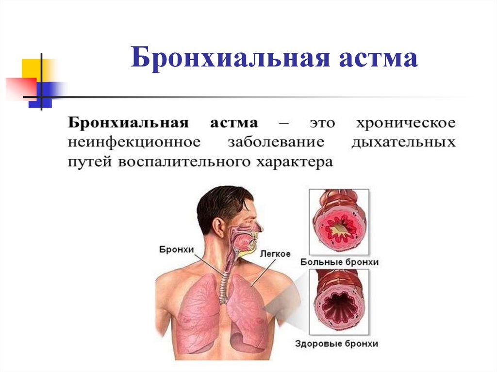 Бронхиальная астма