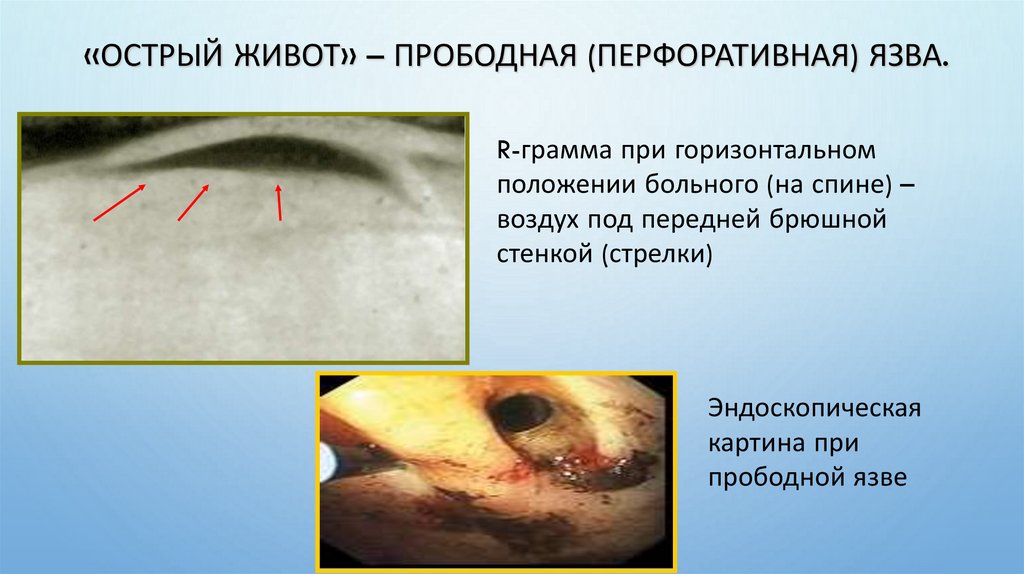 «Острый живот» – прободная (перфоративная) язва.