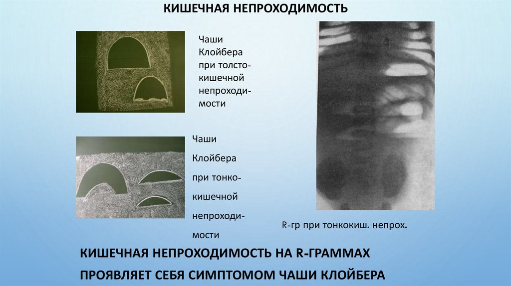 Кишечная непроходимость