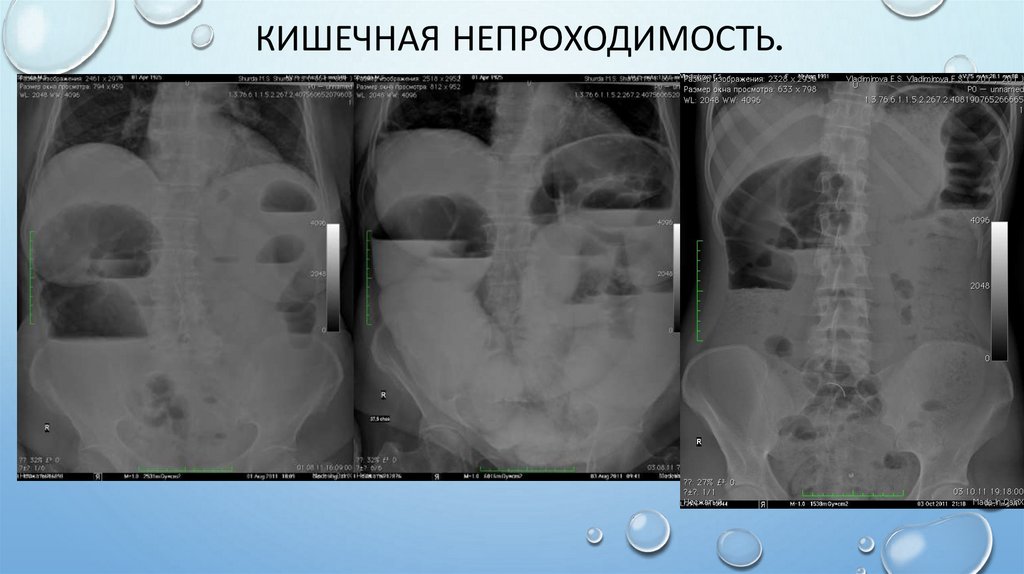 Кишечная непроходимость.
