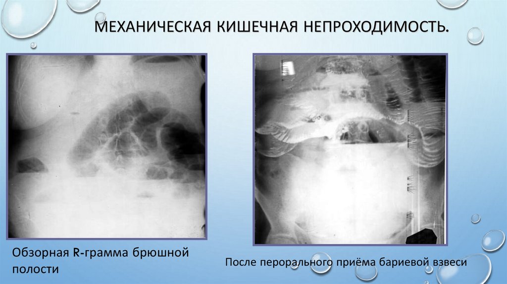 Механическая кишечная непроходимость.