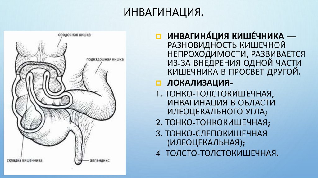 Инвагинация.