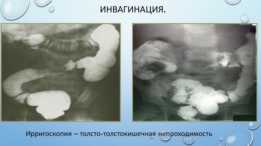 Инвагинация.