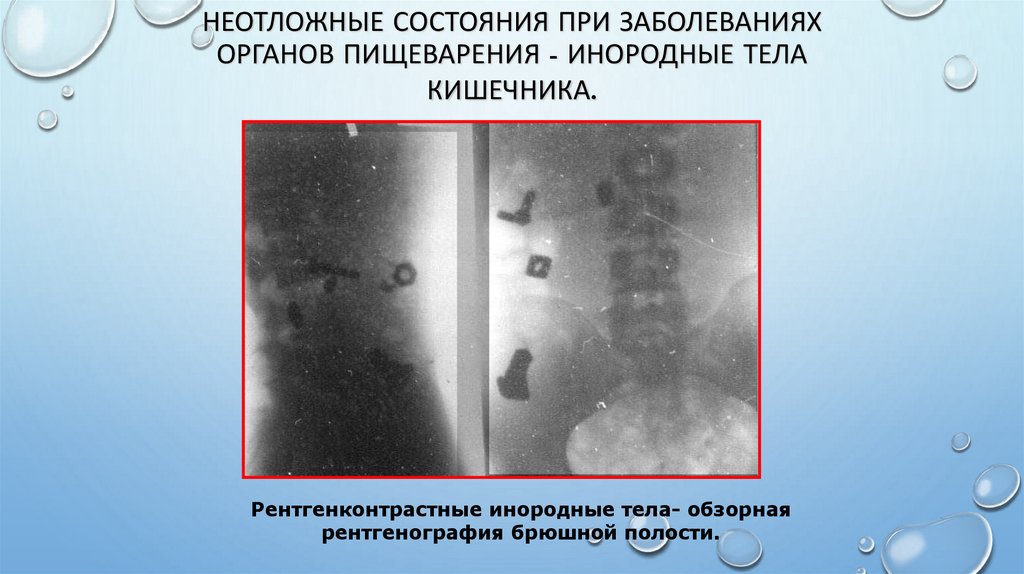Неотложные состояния при заболеваниях органов пищеварения - инородные тела кишечника.