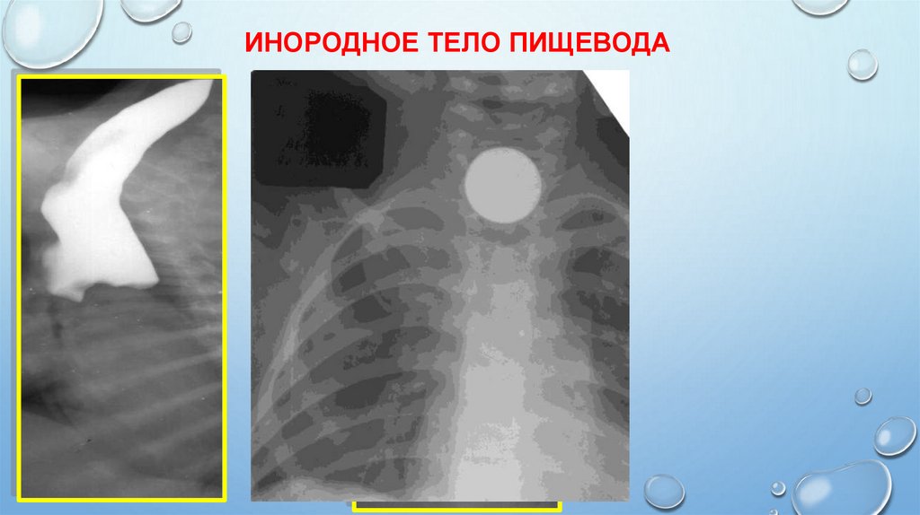 Инородное тело пищевода