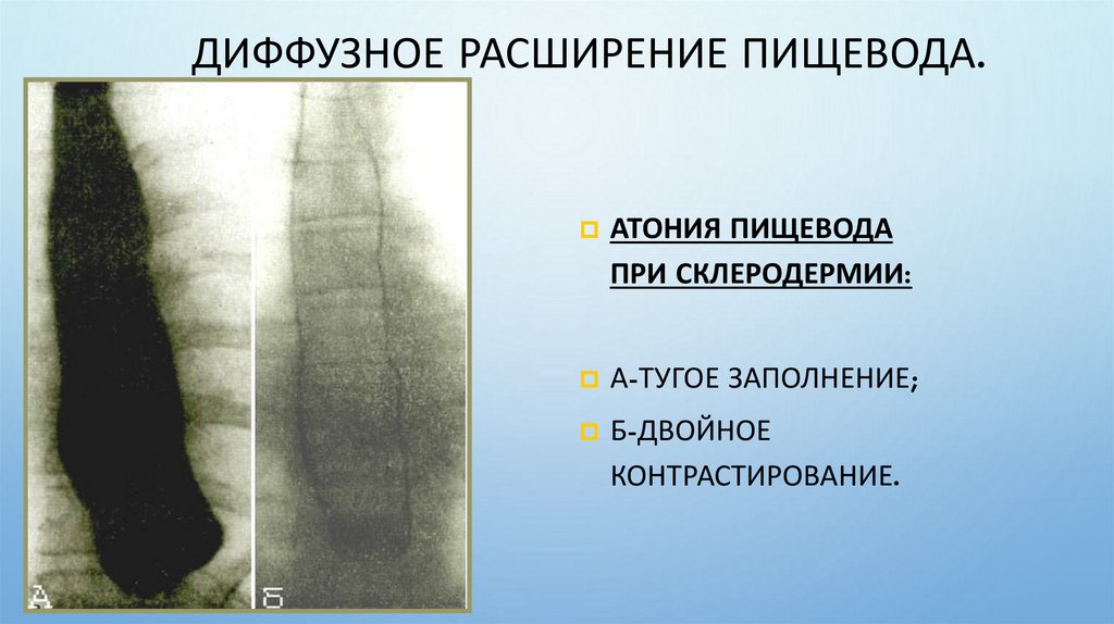 Диффузное расширение пищевода.