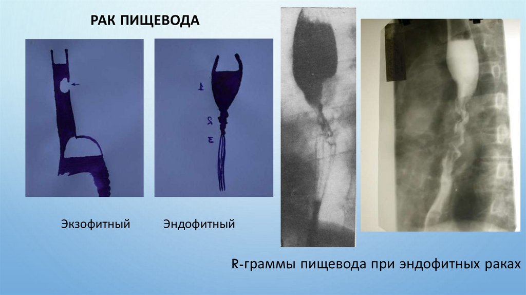 РАК ПИЩЕВОДА