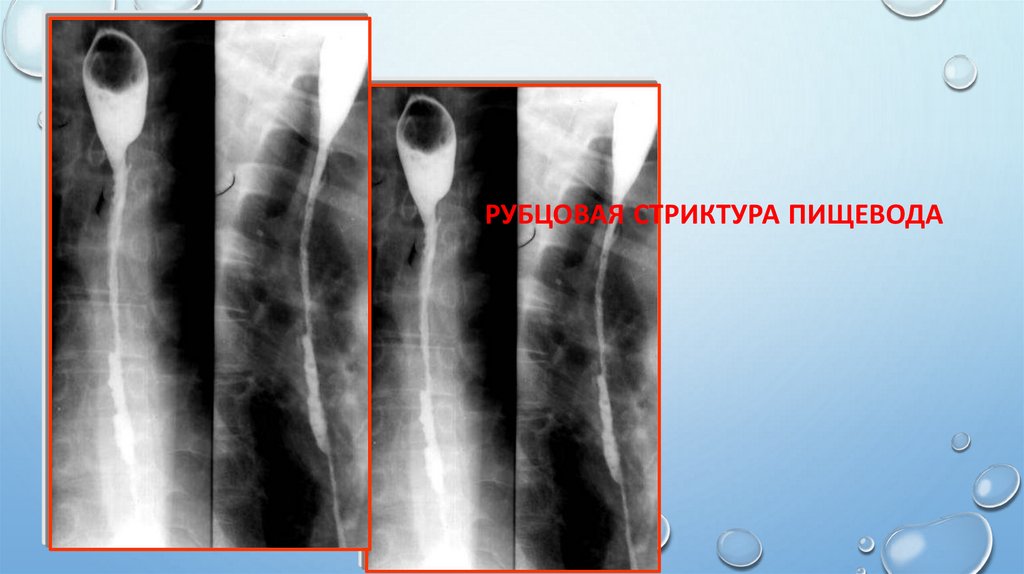 Рубцовая стриктура пищевода