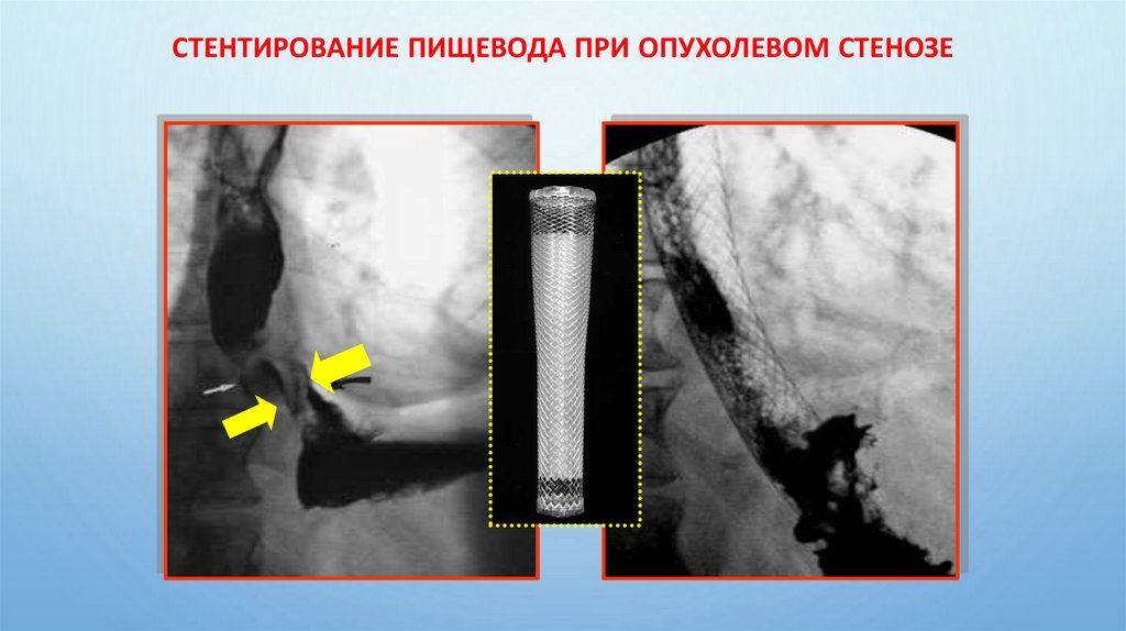 Стентирование пищевода при опухолевом стенозе