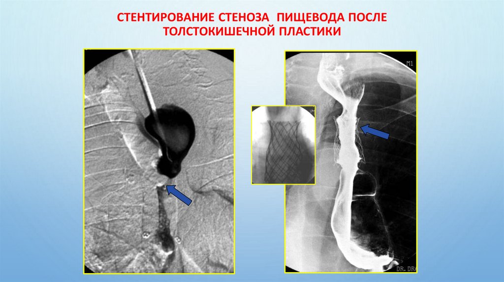 Стентирование стеноза пищевода после толстокишечной пластики