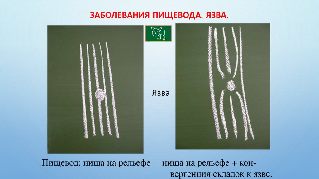 Заболевания пищевода. Язва.