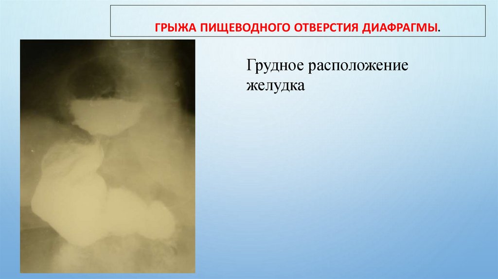 Грыжа пищеводного отверстия диафрагмы.