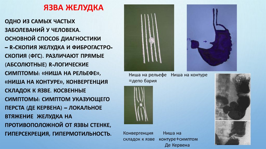 Язва желудка