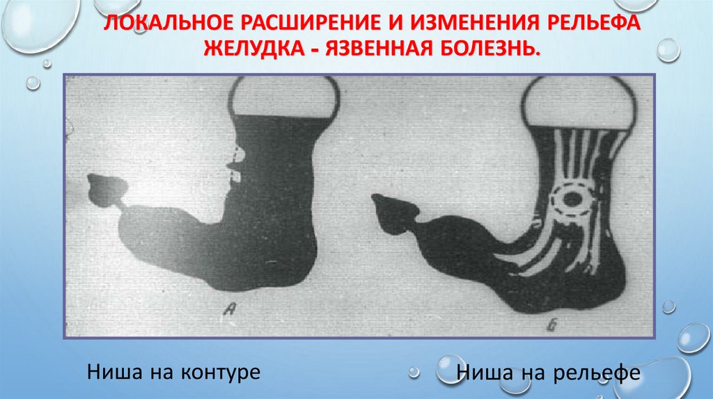 Локальное расширение и изменения рельефа желудка - Язвенная болезнь.