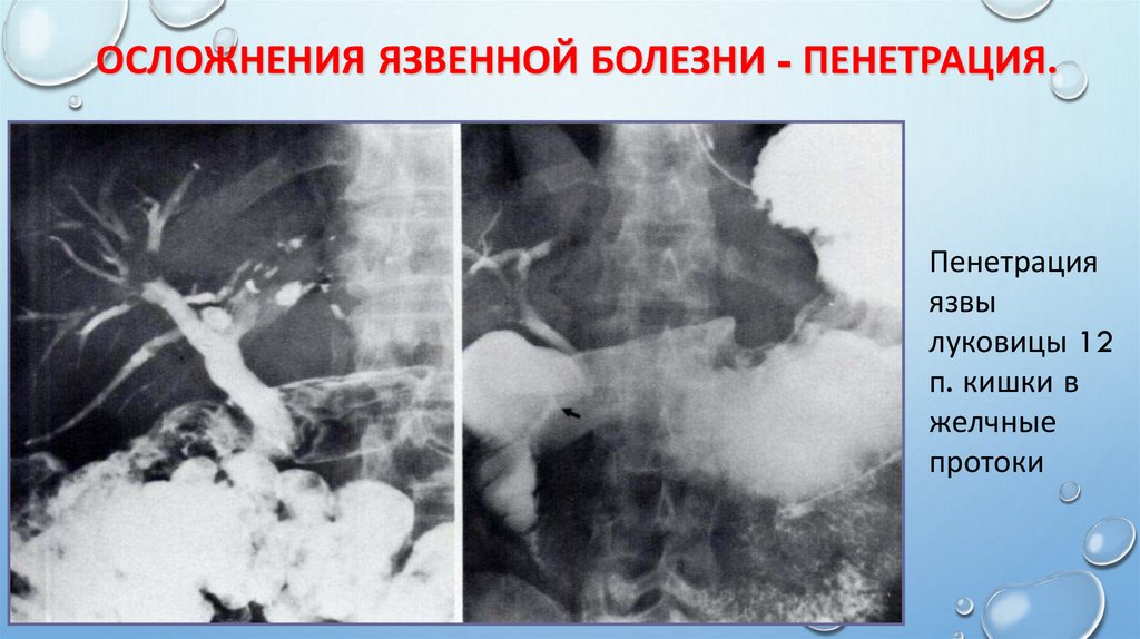 Осложнения язвенной болезни - пенетрация.