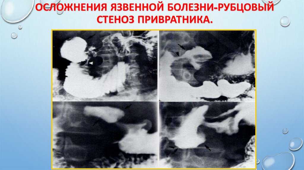 Осложнения язвенной болезни-рубцовый стеноз привратника.