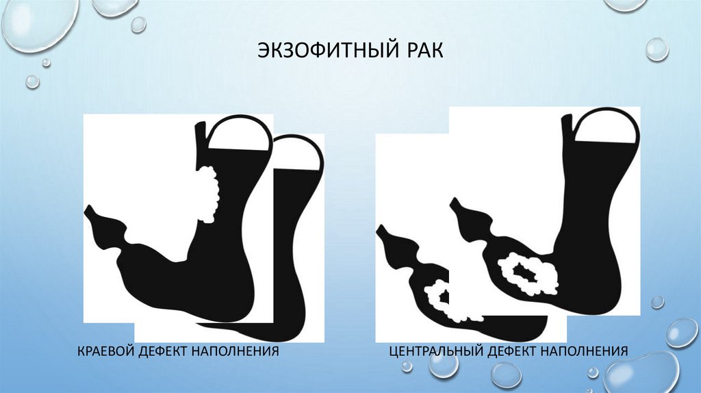 Экзофитный рак