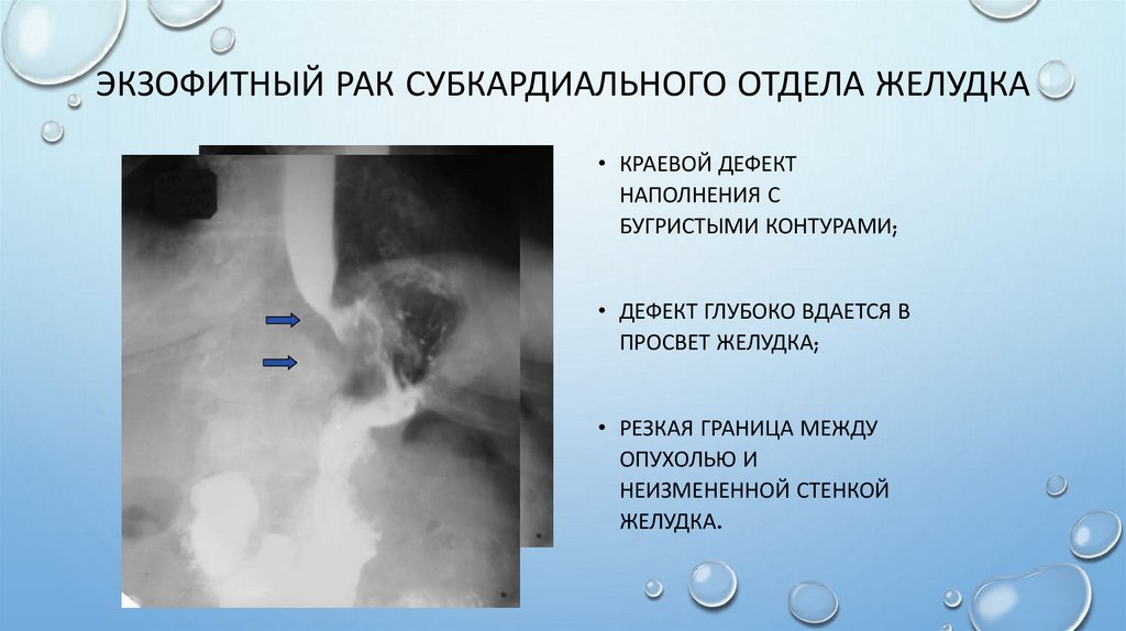 Экзофитный рак субкардиального отдела желудка