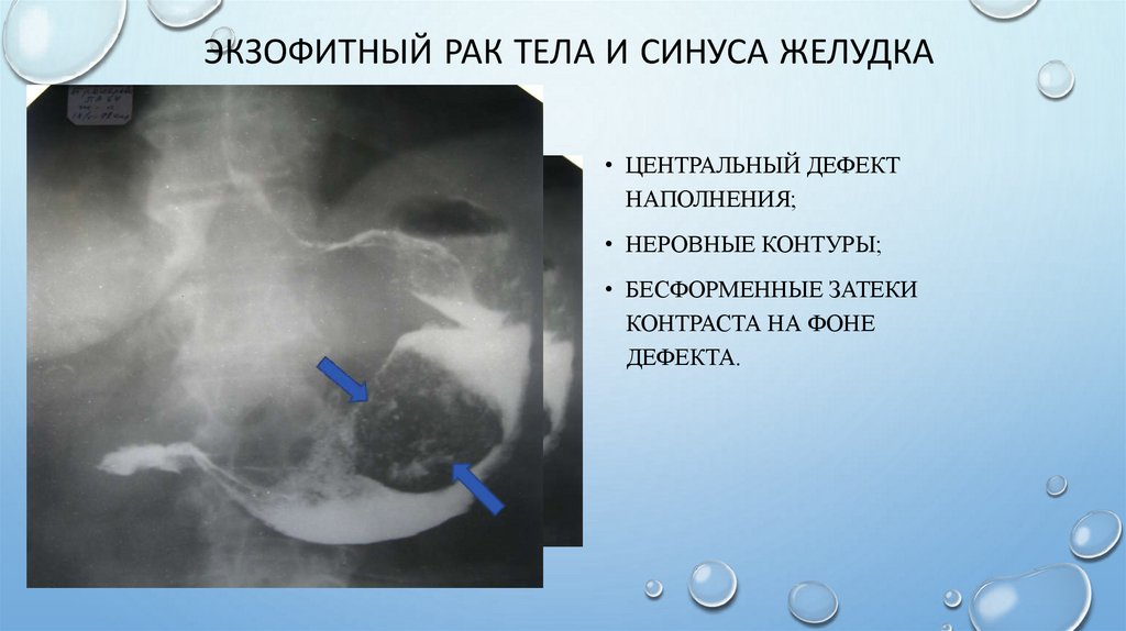 Экзофитный рак тела и синуса желудка