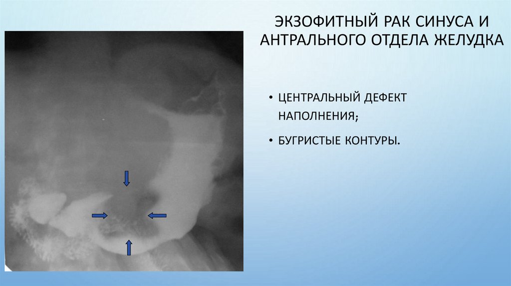 Экзофитный рак синуса и антрального отдела желудка