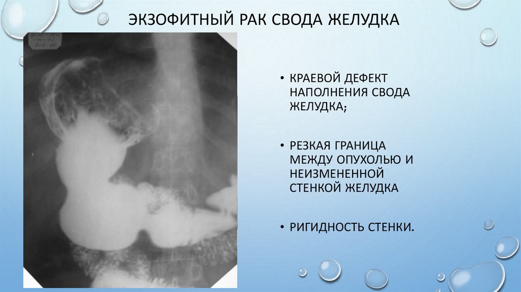 Экзофитный рак свода желудка