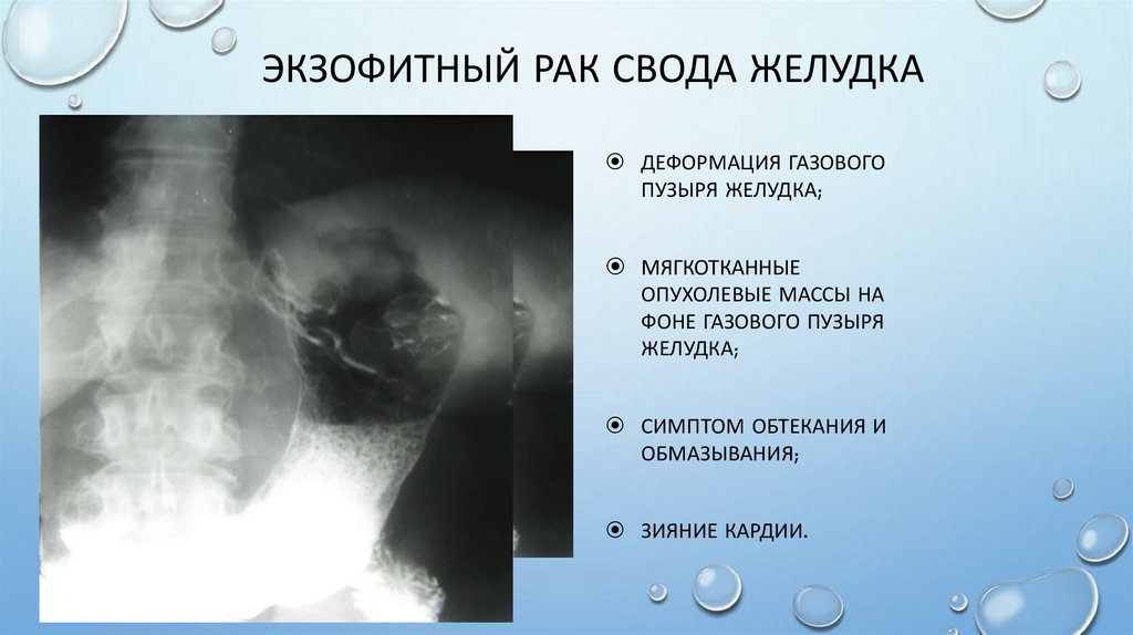 Экзофитный рак свода желудка