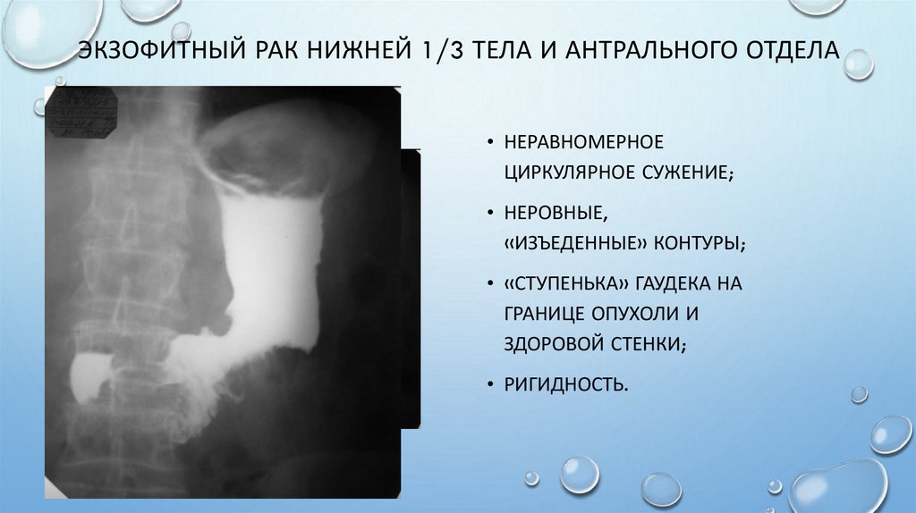Экзофитный рак нижней 1/3 тела и антрального отдела
