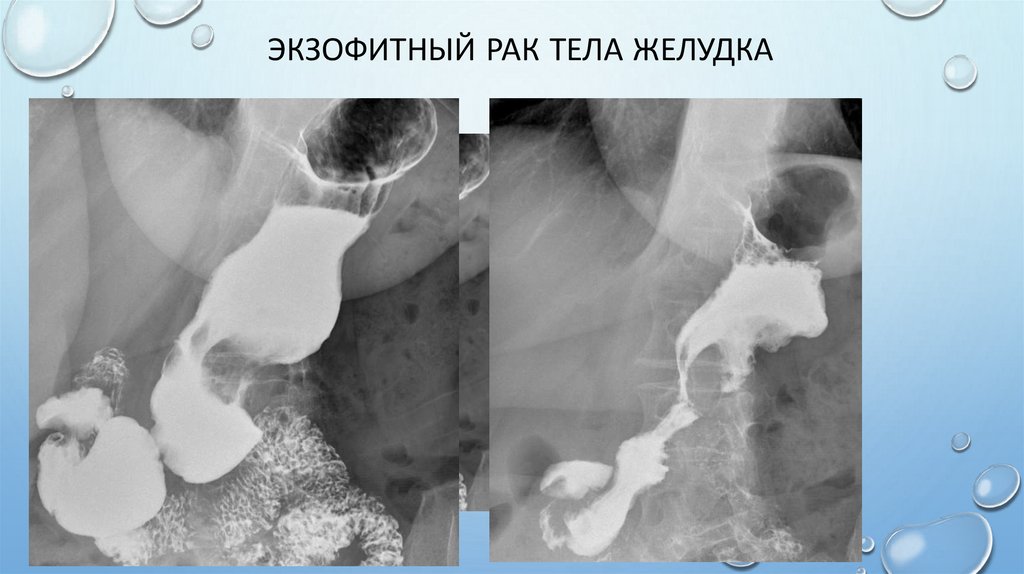 Экзофитный рак тела желудка