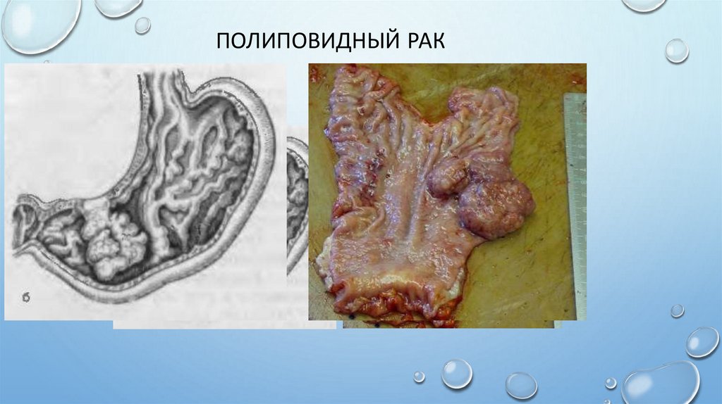Полиповидный рак