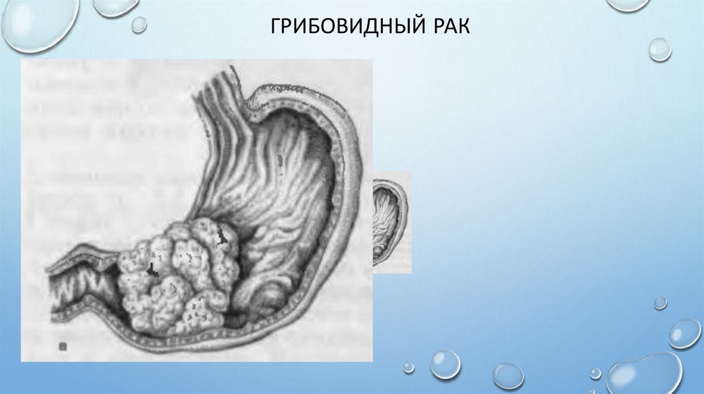 Грибовидный рак