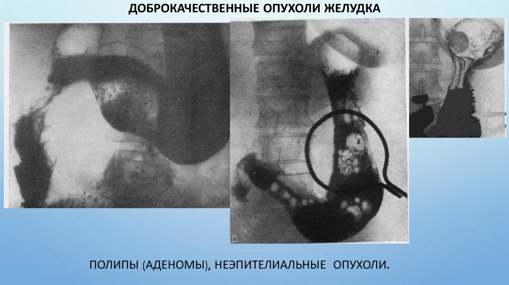 Доброкачественные опухоли желудка
