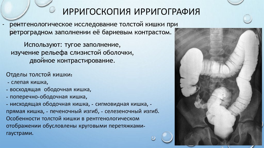 Ирригоскопия ирригография