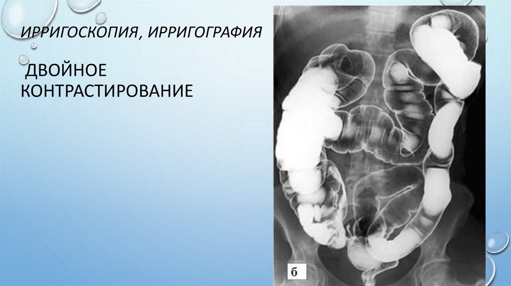 Ирригоскопия, ирригография двойное контрастирование