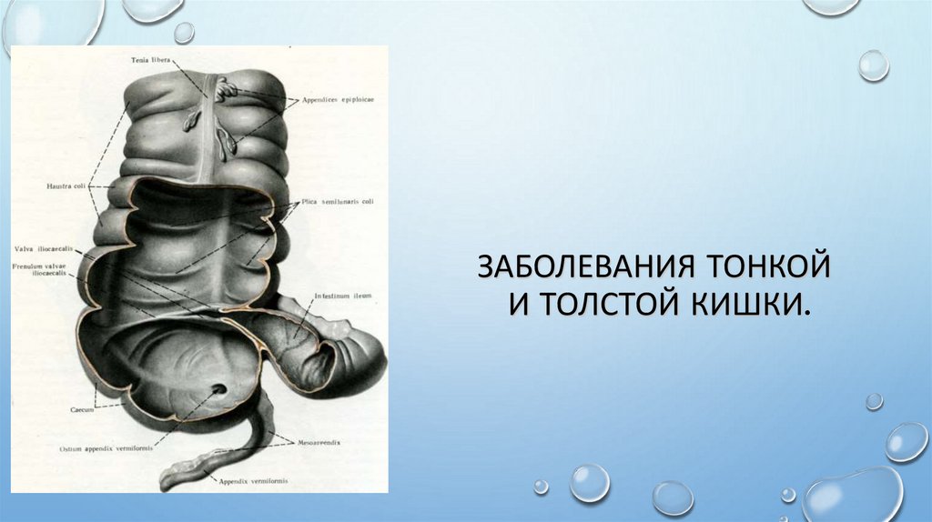 Заболевания тонкой и толстой кишки.