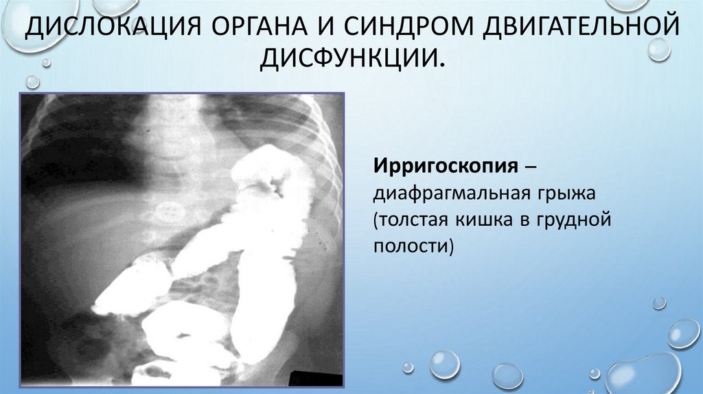 Дислокация органа и синдром двигательной дисфункции.