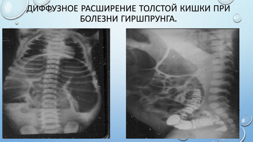 Диффузное расширение толстой кишки при болезни Гиршпрунга.