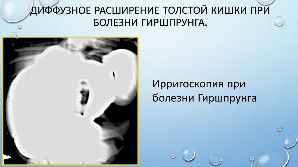 Диффузное расширение толстой кишки при болезни Гиршпрунга.
