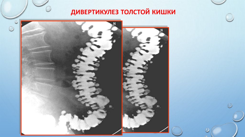 Дивертикулез толстой кишки