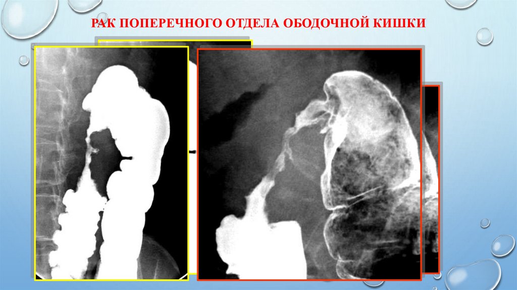 Рак поперечного отдела ободочной кишки